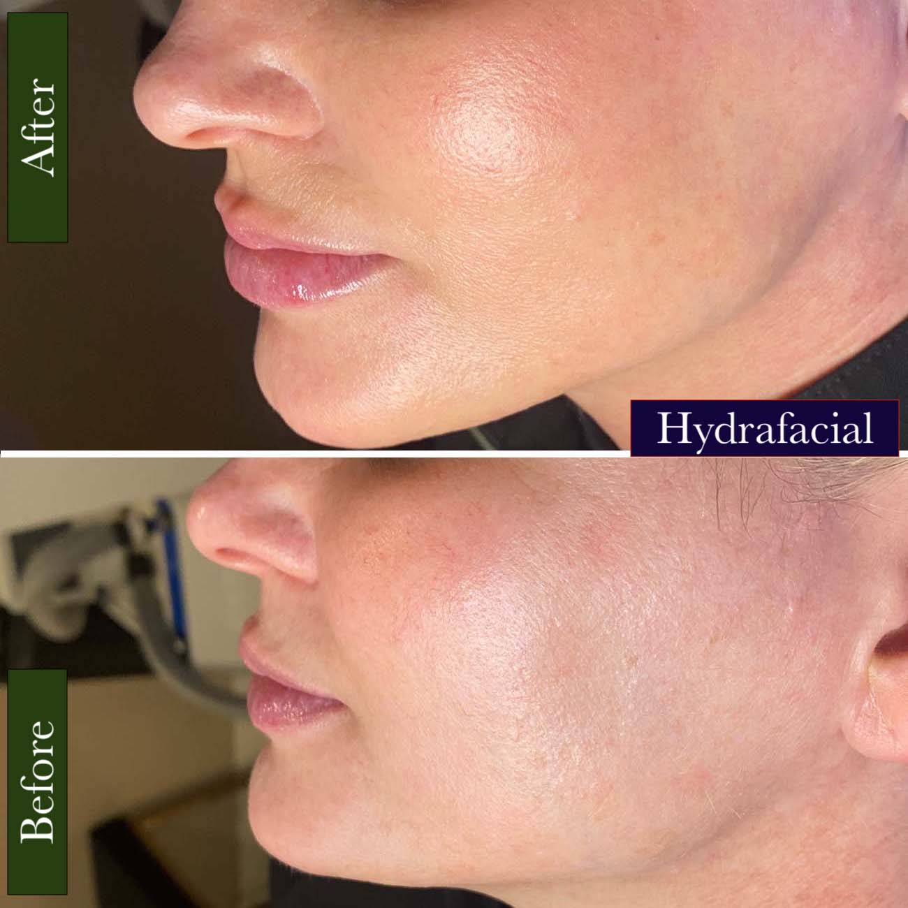 HydraFacial Treatment